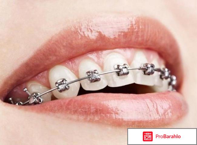 Брекеты металлические 