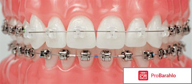 Damon брекеты отрицательные отзывы