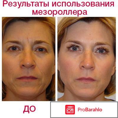 Мезороллер для лица отзывы фото отрицательные отзывы