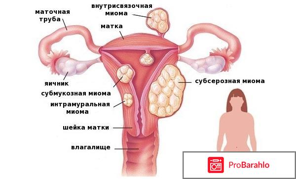 Эпигаллат при миоме обман