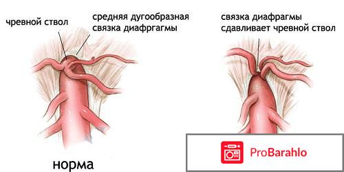 Стеноз чревного ствола симптомы и лечение 