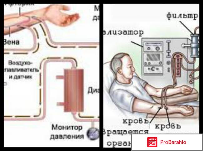 Процедура диализ отрицательные отзывы