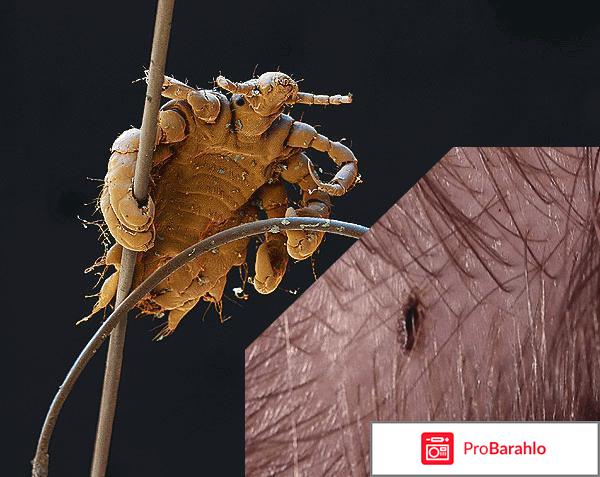 Как вывести вшей в домашних условиях у детей? обман