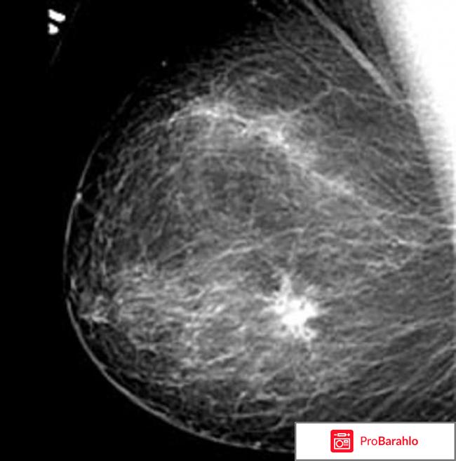 Маммография отрицательные отзывы