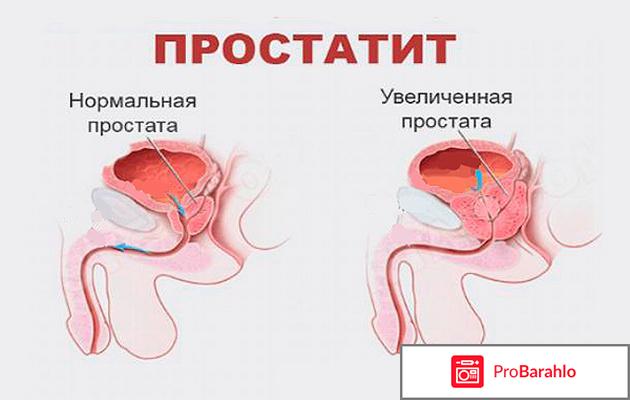 Лечение простатита народными средствами в домашних условиях 