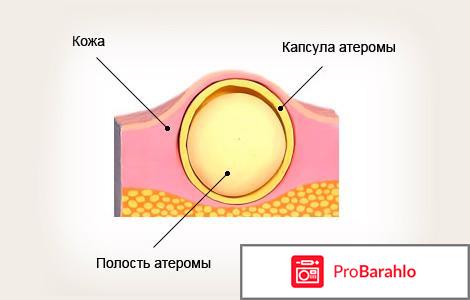 Удаление атеромы 