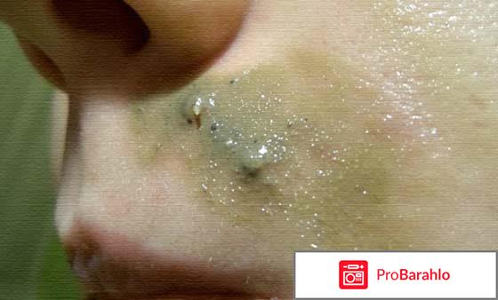 Мазь ям от лишая у человека отзывы отрицательные отзывы