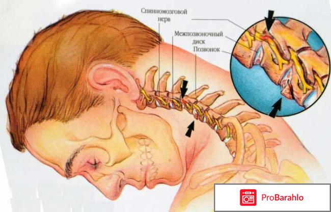 Лечение гипоплазии правой позвоночной артерии 2017 
