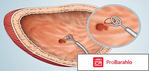 Цистоскопия отзывы женщин отрицательные отзывы