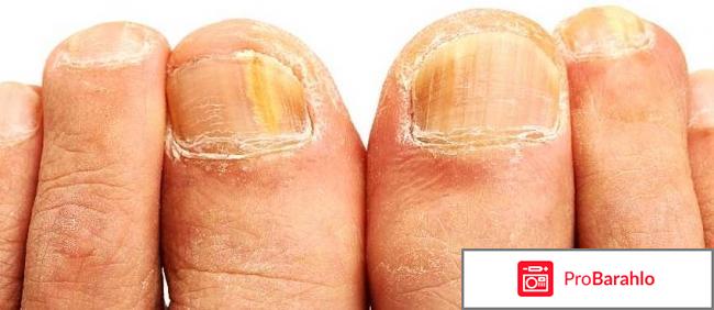 Крем Tinedol (Тинедол) от грибка: обман или правда 