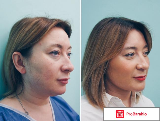 Липолитики для подбородка отзывы 