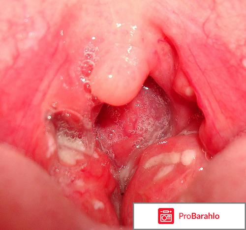 Ангина гнойная лечение в домашних условиях 