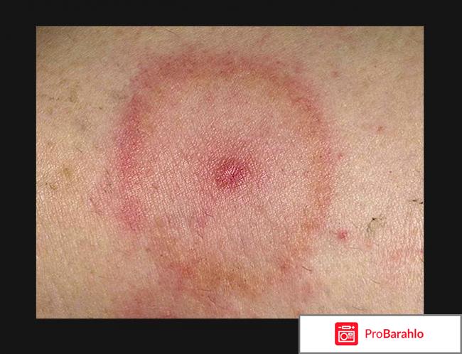 Анализ крови на боррелиоз отрицательные отзывы