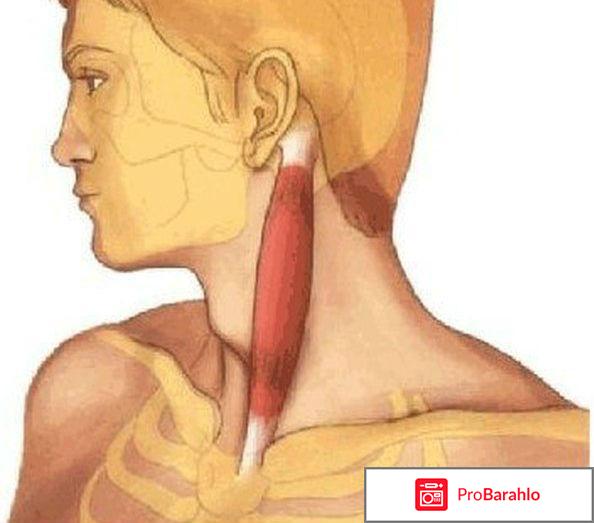 Кривошея у взрослых лечение 