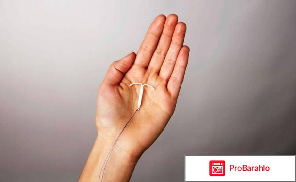 Мирена отзывы женщин после 50 отрицательные отзывы