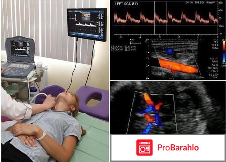 Узи сосудов брахиоцефальной зоны отрицательные отзывы