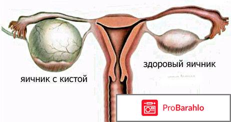 Лапароскопия кисты яичника 