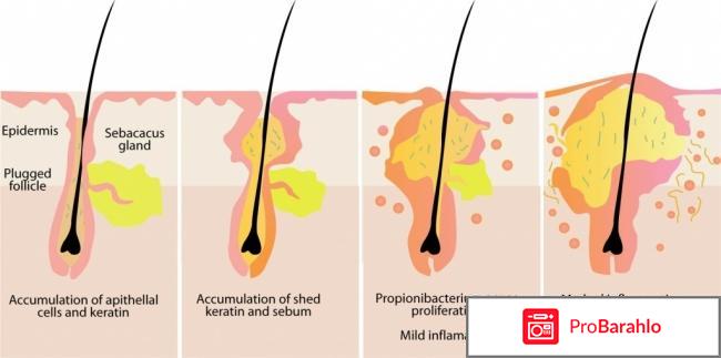 Воспаление волосяных луковиц 