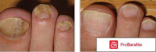 Сангридок от грибка обман