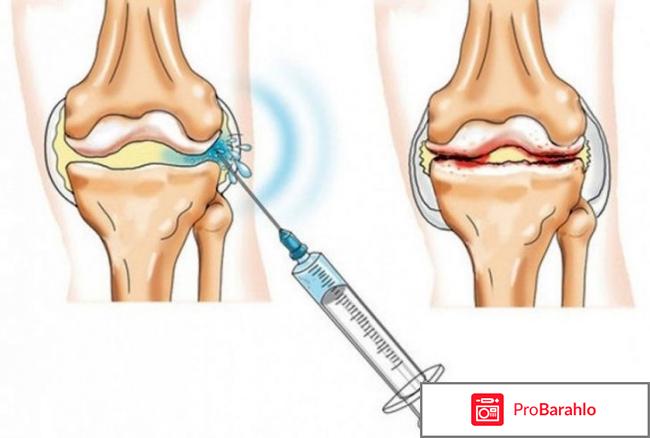 Купить гиалуроновую кислоту для инъекций в колено отрицательные отзывы