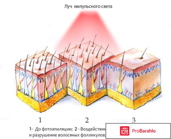 Фотоэпиляция отзывы отрицательные отзывы