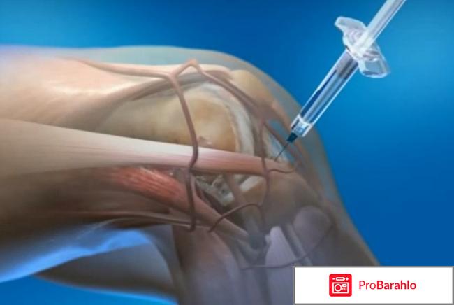 Остенил инструкция по применению цена отзывы аналоги реальные отзывы