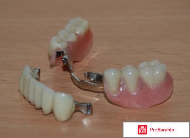 Бюгельное протезирование отрицательные отзывы