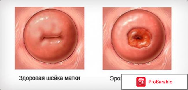 Лечение эррозии народными средствами обман