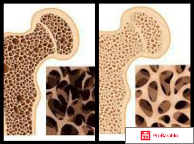 Остерепар инструкция по применению цена отзывы 