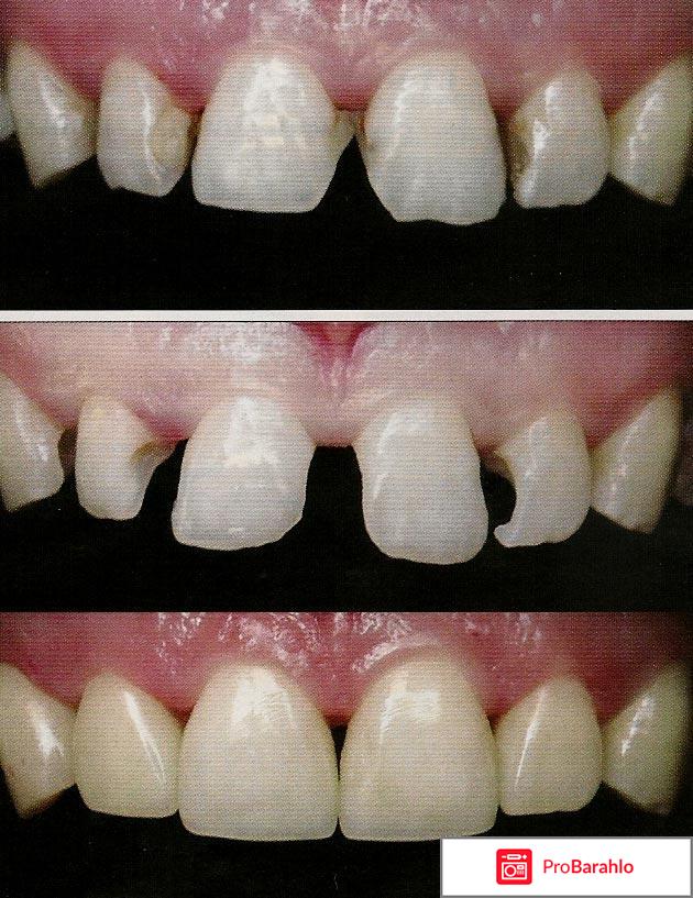 Художественная реставрация передних зубов 