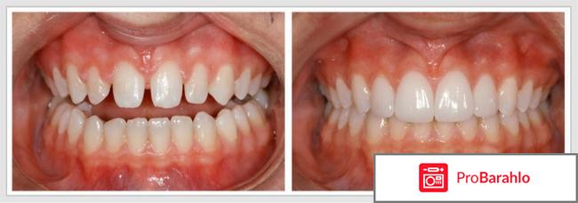 Виниры отзывы отрицательные отзывы владельцев