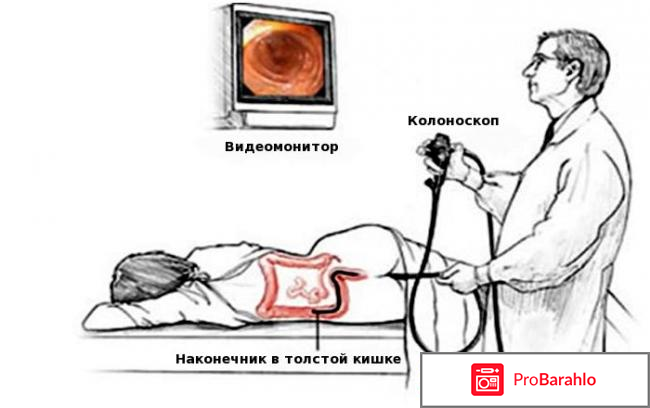 Больно ли делать колоноскопию обман