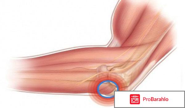 Эпикондилит локтевого сустава лечение народными средствами отрицательные отзывы