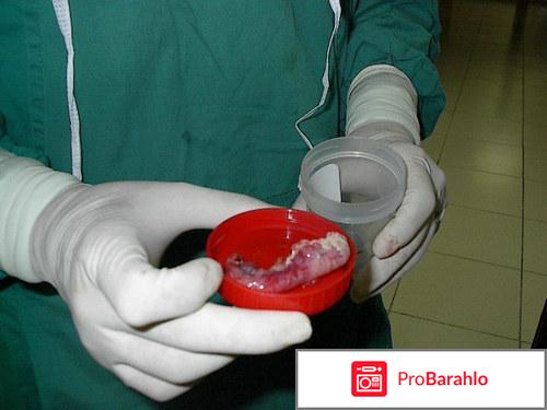 Где находится аппендицит отрицательные отзывы