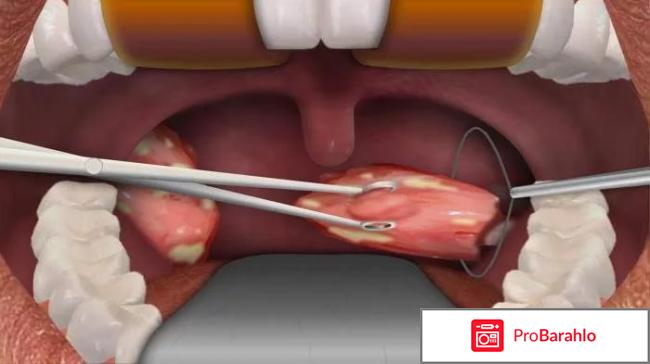 Холодноплазменная тонзиллэктомия отзывы обман