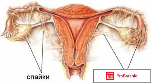 Маточные спайки 