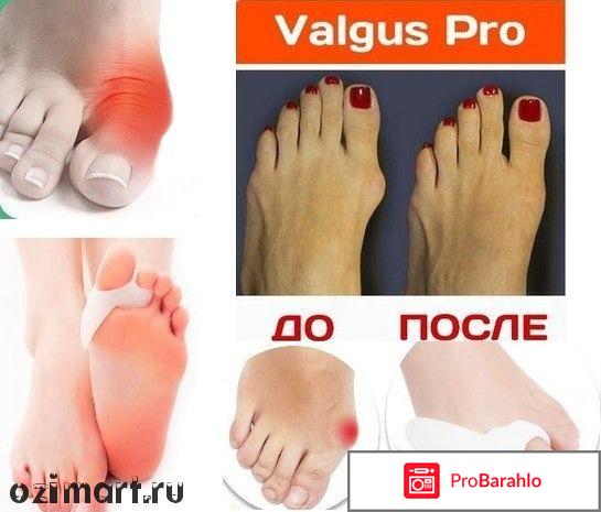 Фиксатор valgus pro отзывы обман