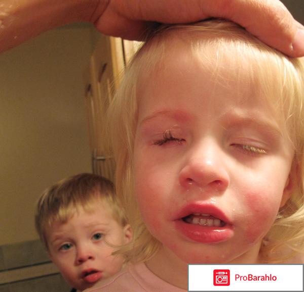 Супер клей попал в глаз что делать 