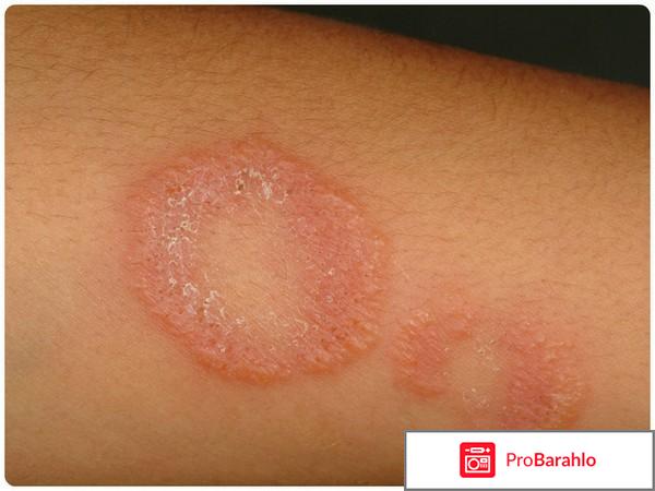 Розовый лишай у детей: симптомы и лечение 