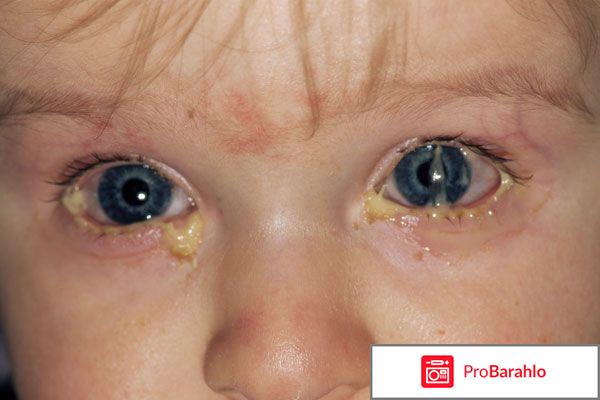 Глаз гноится 