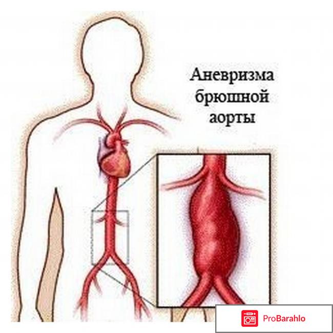 Аневризма аорты сердца что это такое 