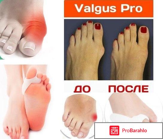 Реальные отзывы valgus pro реальные отзывы