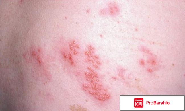 Опоясывающий герпес: причины, симптомы, лечение отрицательные отзывы