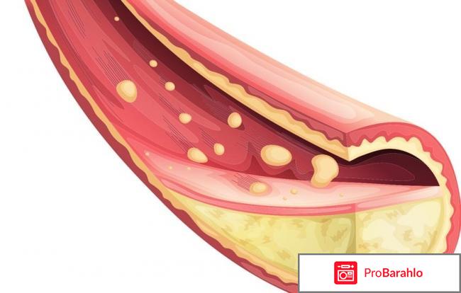 Aterol для снижения холестерина: обзор, цена, купить отрицательные отзывы