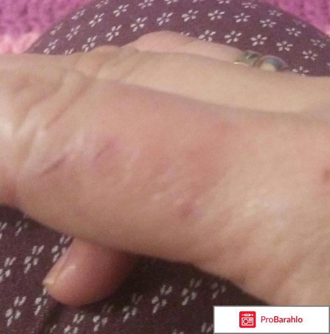 Крем Канизон реальные отзывы