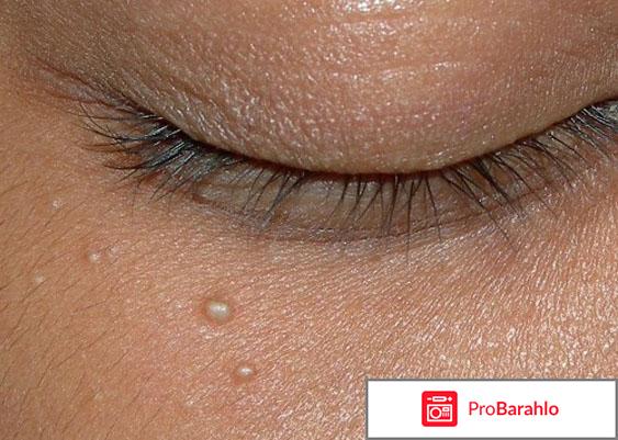 Жировики под глазами: почему они возникают 