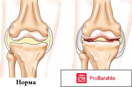 Плазмолифтинг коленного сустава отзывы отрицательные отзывы