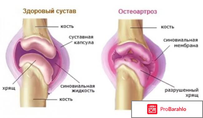 Артрокер больных 