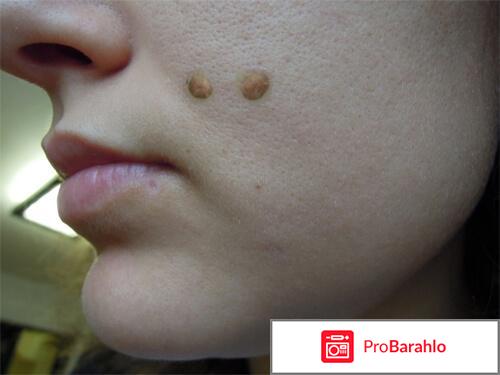 Papilight Comfort отзывы владельцев