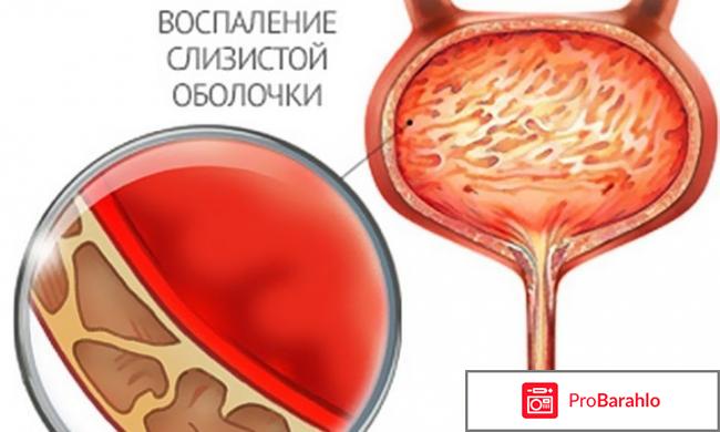 Отзывы уротропин обман